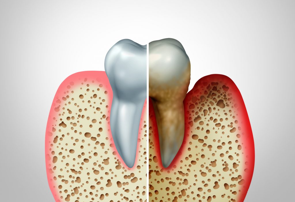 Gum disease & healthy teeth comparison