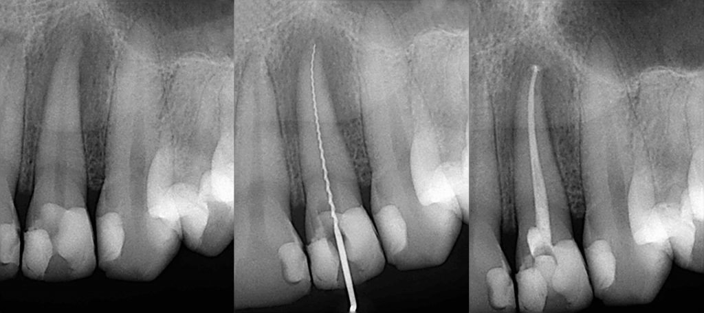 x-ray images of root canal procedure